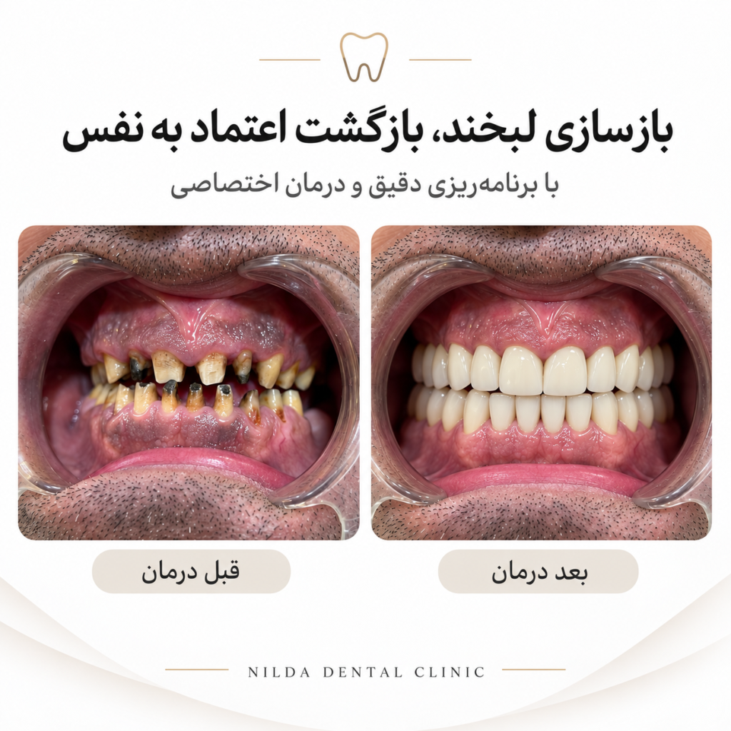 تصویر قبل و بعد درمان دندانپزشکی در کلینیک نیلدا، بدون نمایش چهره