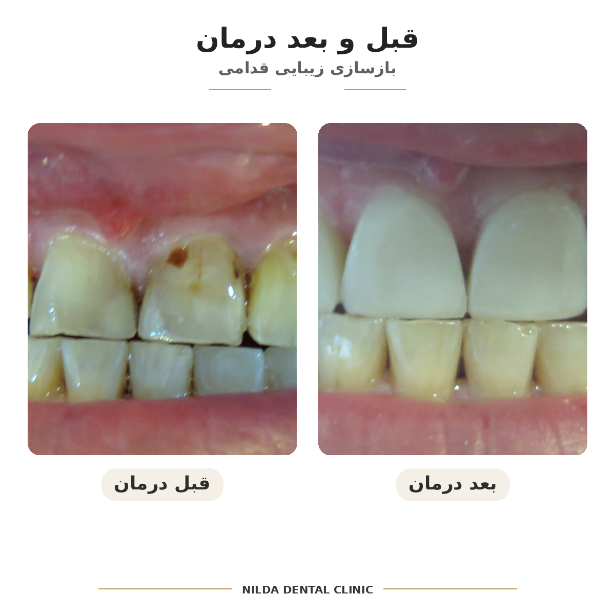 نمونه قبل و بعد نیلدا — کیس ۰۰۳ — بدون نمایش چهره قابلشناسایی