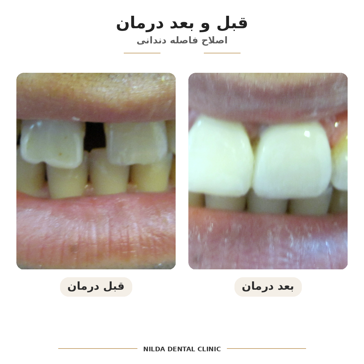 نمونه قبل و بعد نیلدا — کیس ۰۰۴ — بدون نمایش چهره قابلشناسایی