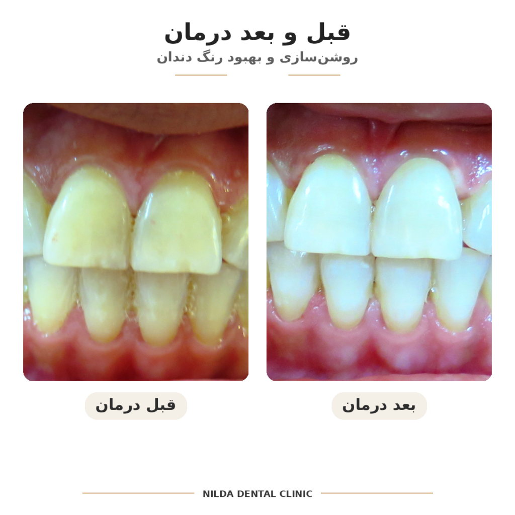 نمونه قبل و بعد درمان دندانپزشکی در کلینیک نیلدا، کیس ۰۰۵، بدون نمایش چهره