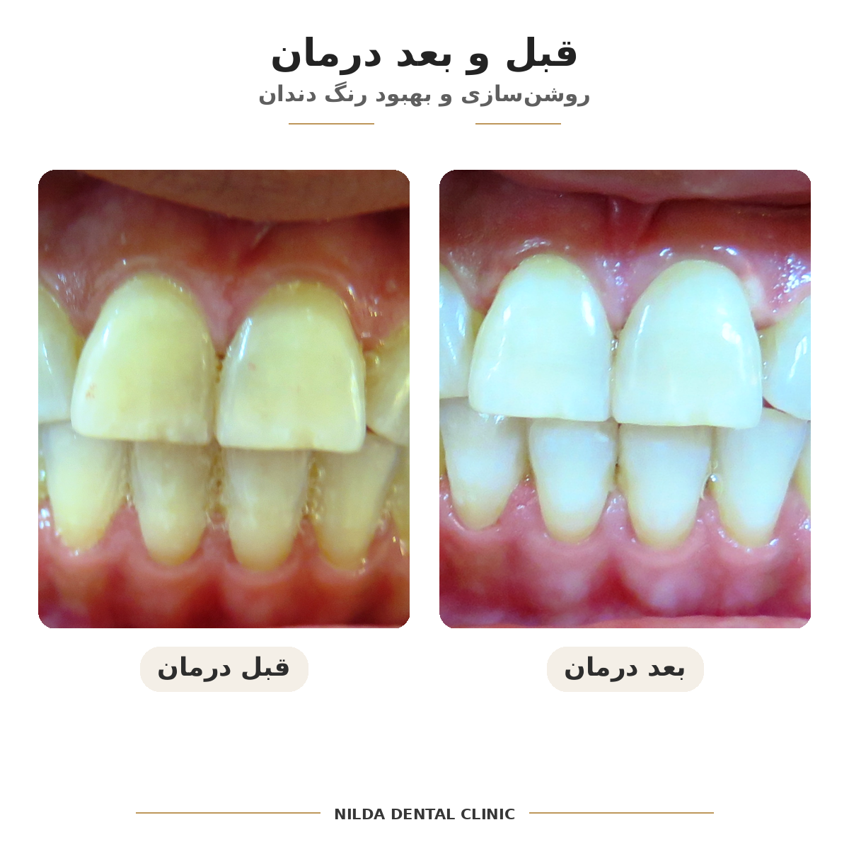 نمونه قبل و بعد نیلدا — کیس ۰۰۵ — بدون نمایش چهره قابلشناسایی