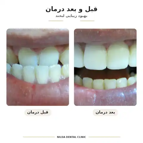 نمونه قبل و بعد نیلدا — کیس ۰۰۹ — بدون نمایش چهره قابلشناسایی