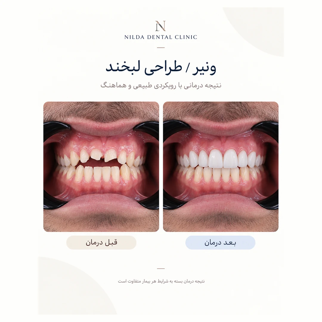 Nilda Dental Clinic real before-and-after case 001 | کیس واقعی قبل و بعد نیلدا | حالة حقيقية قبل وبعد العلاج في نيلدا