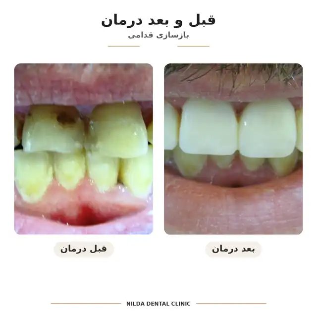 نمونه قبل و بعد نیلدا — کیس ۰۱۰ — بدون نمایش چهره قابلشناسایی