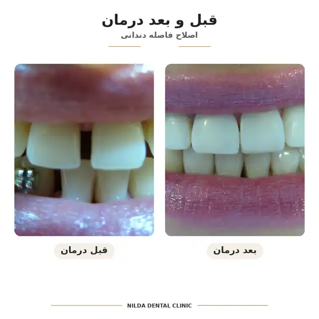 نمونه قبل و بعد نیلدا — کیس ۰۱۱ — بدون نمایش چهره قابلشناسایی