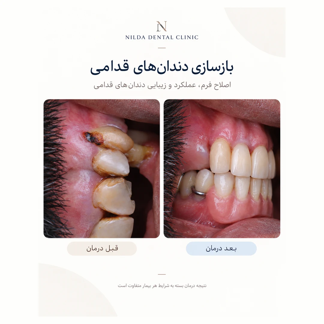 حالة نيلدا المعتمدة قبل وبعد العلاج 002 — ترميم الأسنان الأمامية