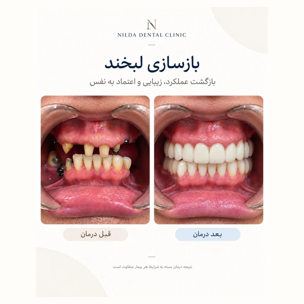 Nilda Dental Clinic real before-and-after case 003, full smile rehabilitation | کیس واقعی قبل و بعد ۰۰۳ نیلدا، بازسازی کامل لبخند | حالة حقيقية قبل وبعد العلاج 003 في نيلدا، إعادة تأهيل كاملة للابتسامة