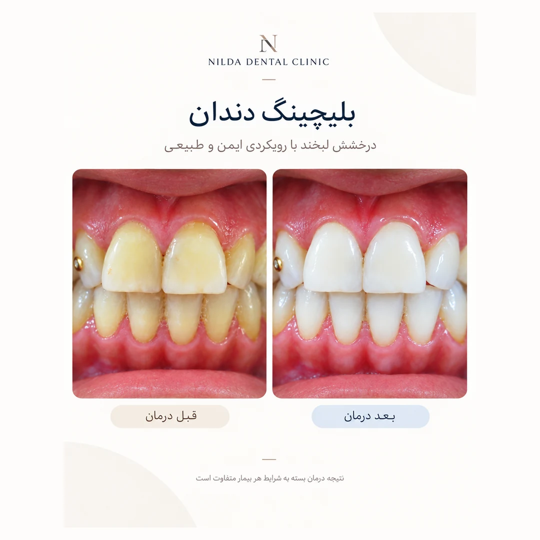 حالة نيلدا المعتمدة قبل وبعد العلاج 004 — تبييض الأسنان