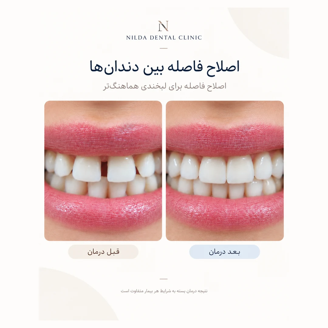 حالة نيلدا المعتمدة قبل وبعد العلاج 005 — إغلاق الفراغات بين الأسنان