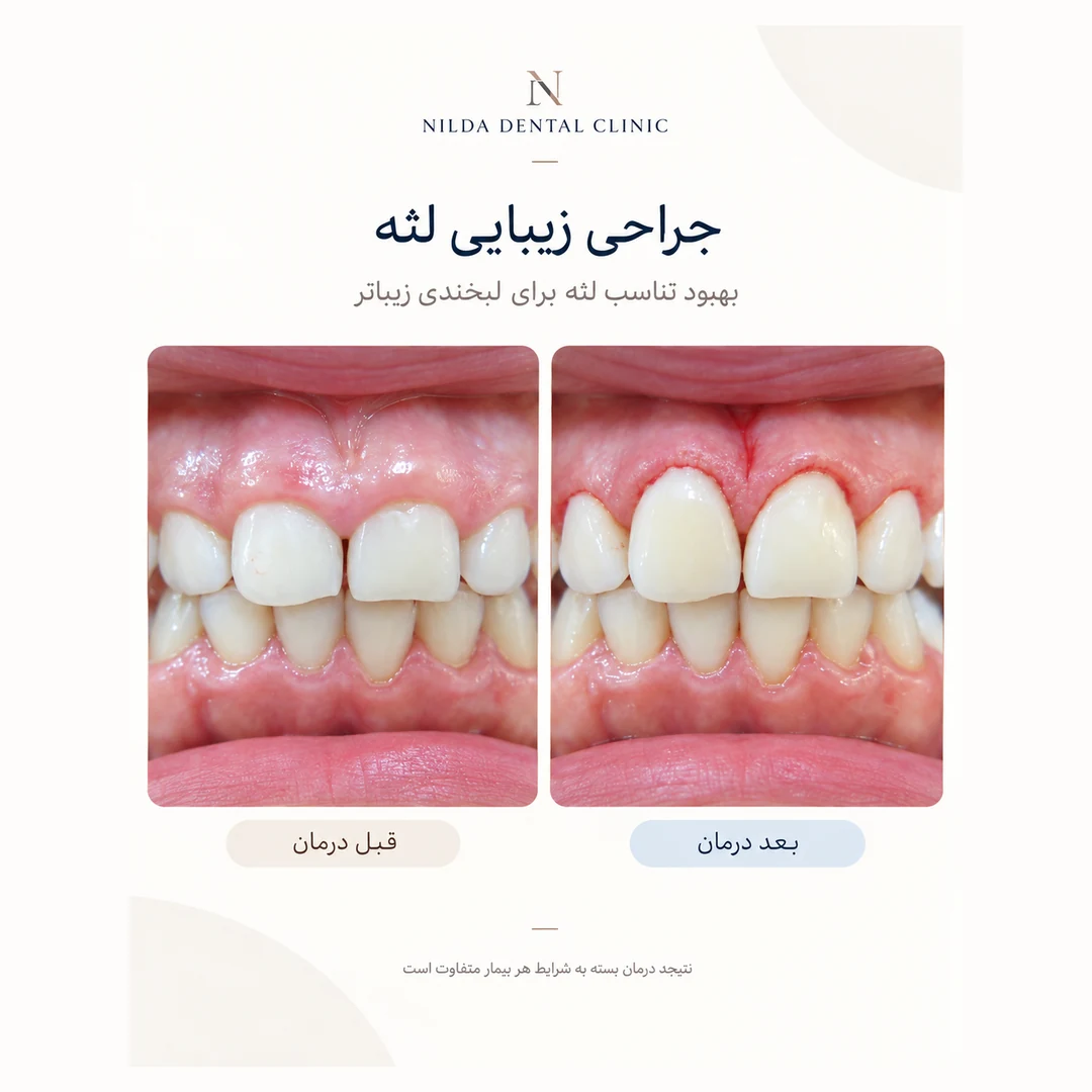 حالة نيلدا المعتمدة قبل وبعد العلاج 007 — جراحة تجميلية للثة