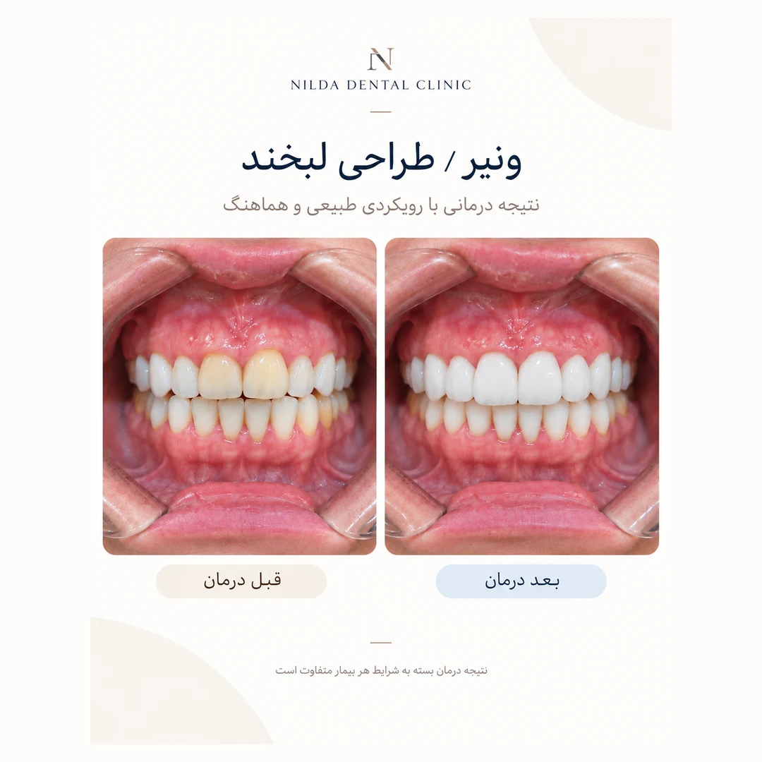 حالة نيلدا المعتمدة قبل وبعد العلاج 008 — قشور وتصميم ابتسامة كلاسيكي