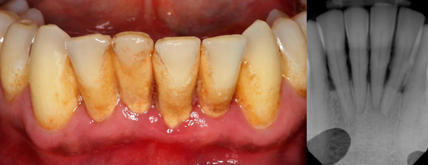 نمای بالینی و رادیوگرافی بیماری پریودنتال برای توضیح ارتباط دیابت با سلامت لثه